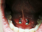 Fotoblog piercingers