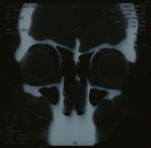 My skull ]:->