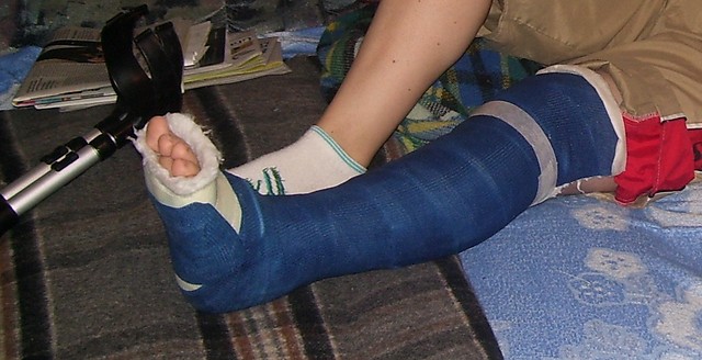 Gips nr 2