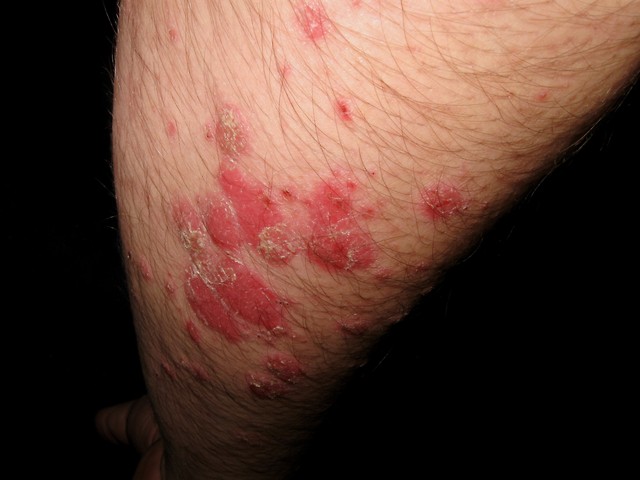 psoriasis