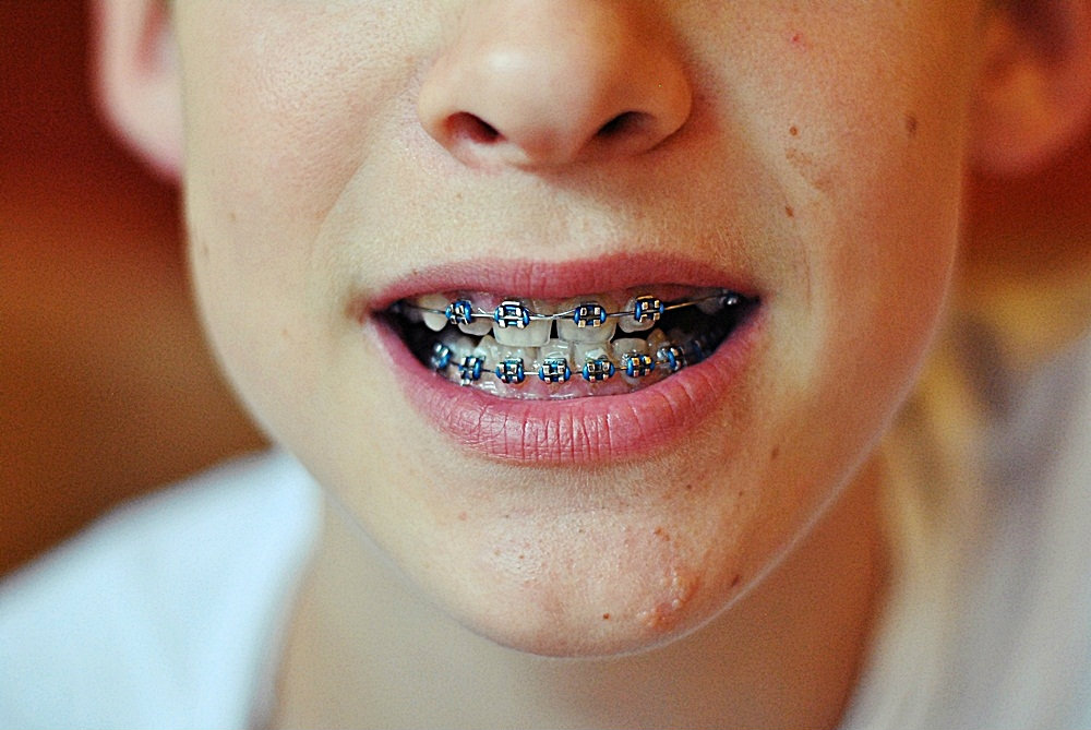 show me yours braces
