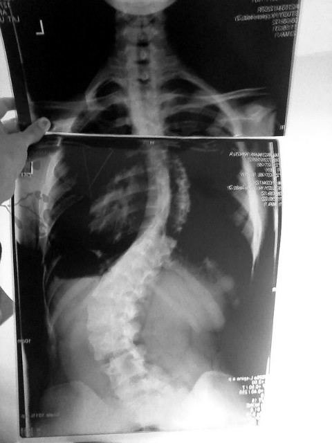 ~ Spinal fusion 