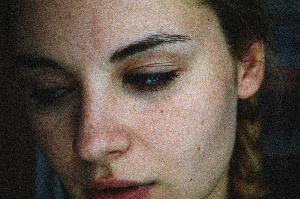 freckles
