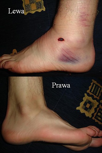 Moja noga :(