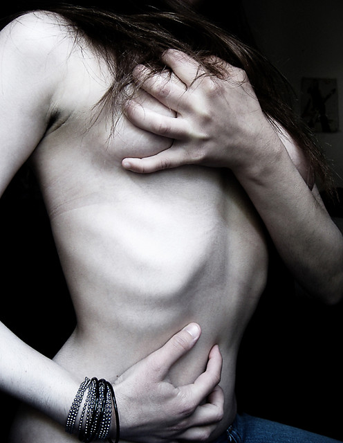 Anorexia Nervosa