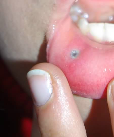 Side labret