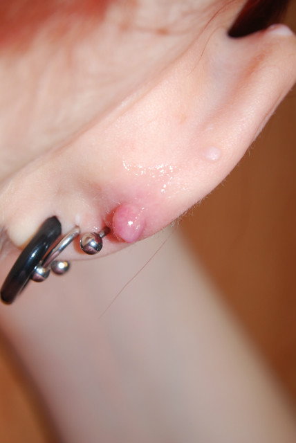 Znowu keloid