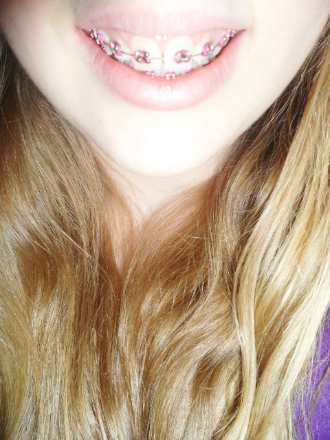 braces