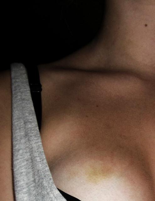 bites